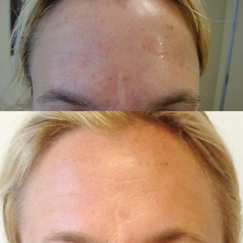 Rachel Forhead Before After